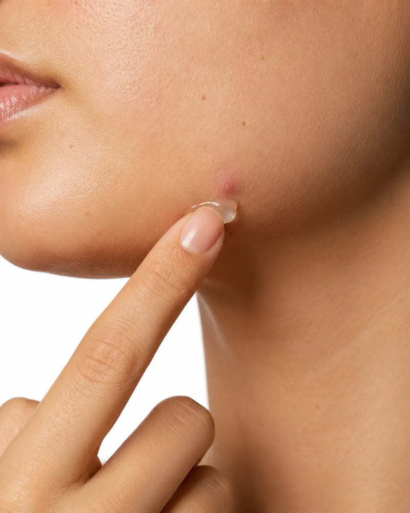 Hormonal Breakouts Along the Jaw