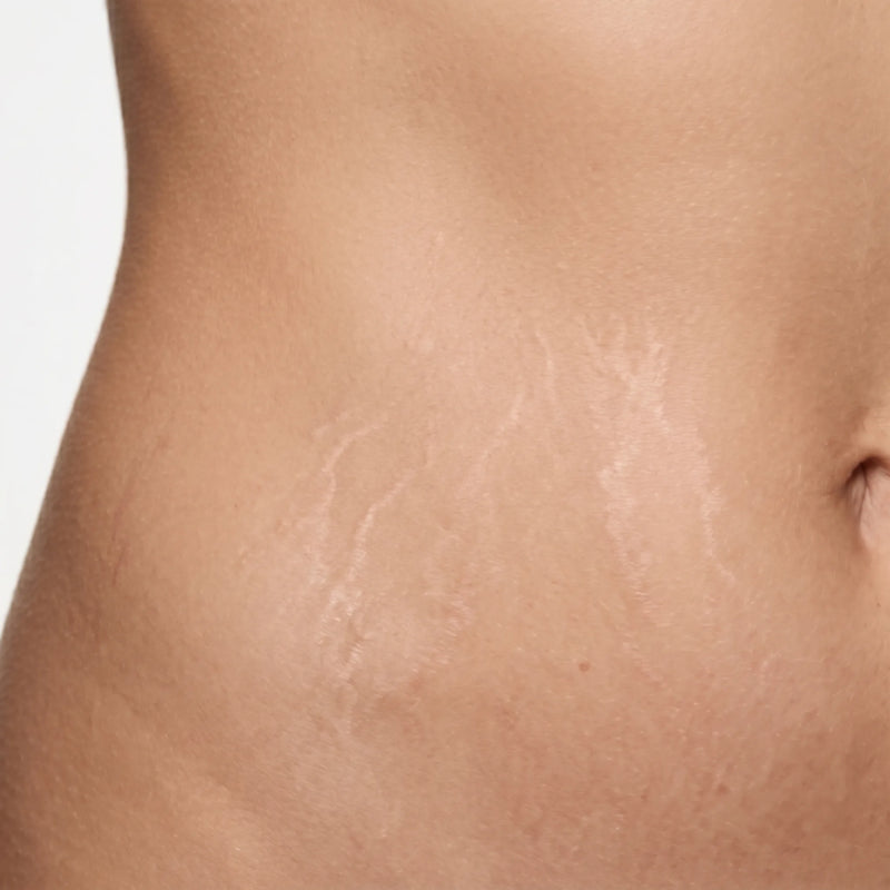 stretch marks