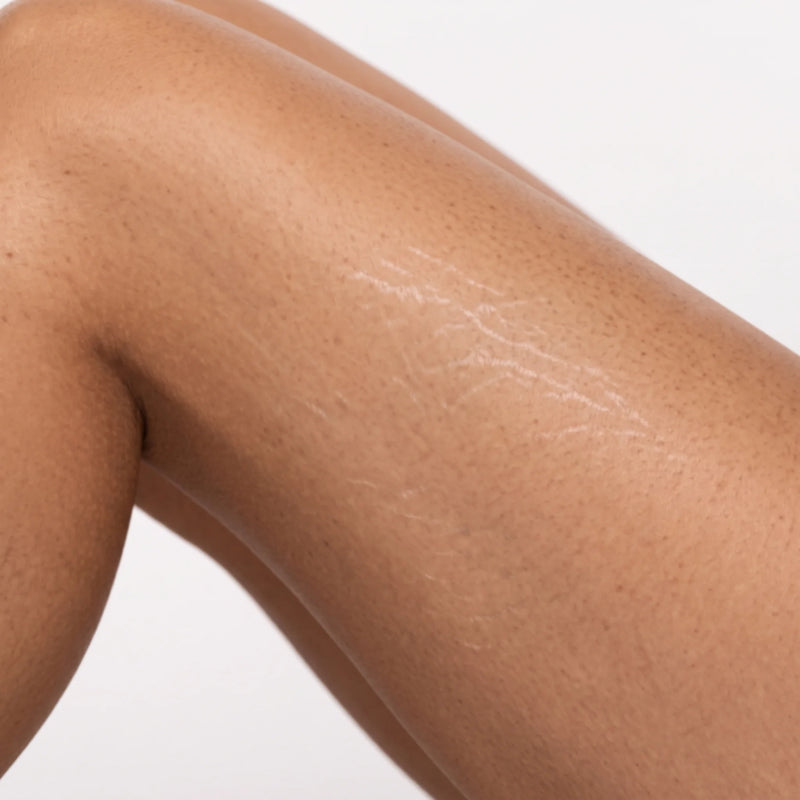 Stretch marks